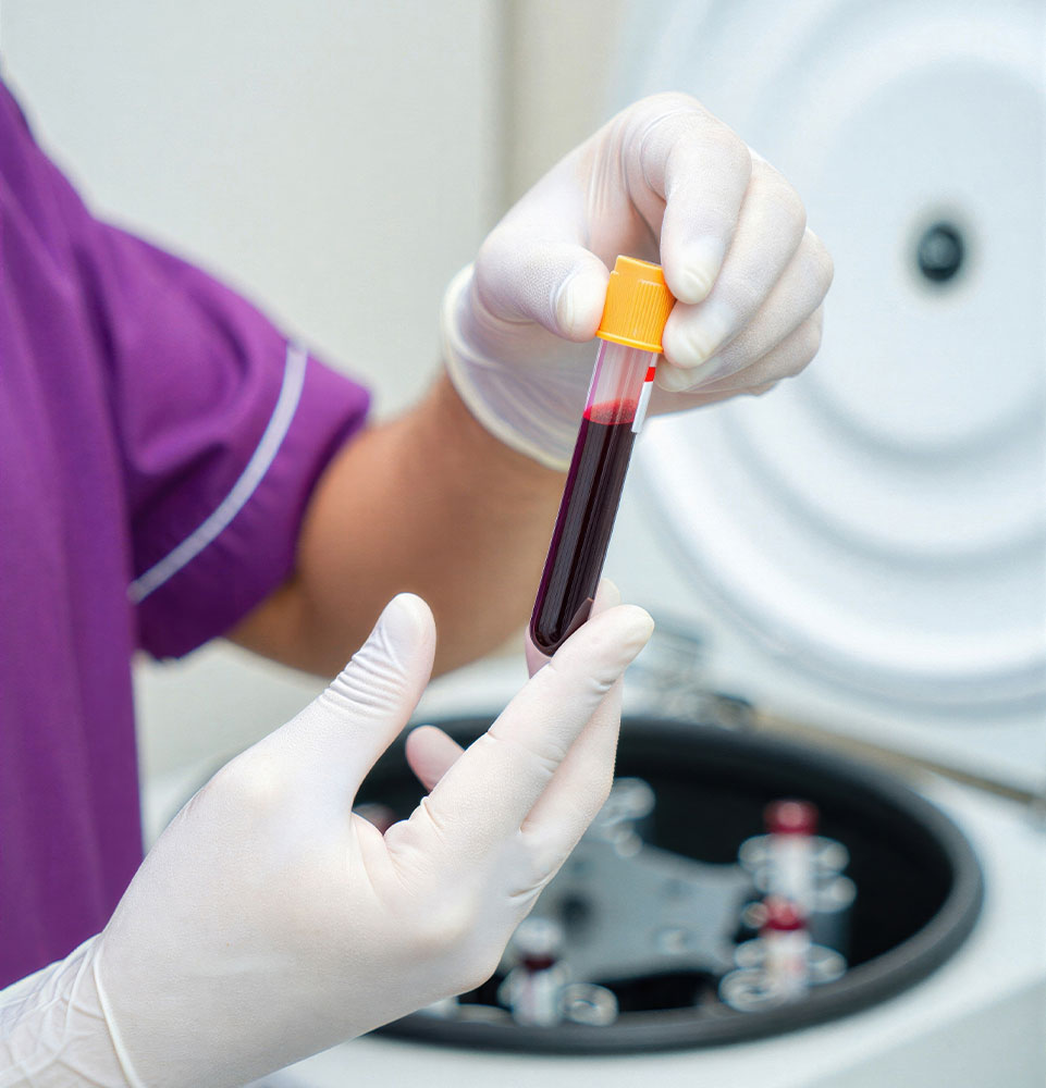 blood plasma separation in aesthetic medicine, laboratory procedure with blood sample