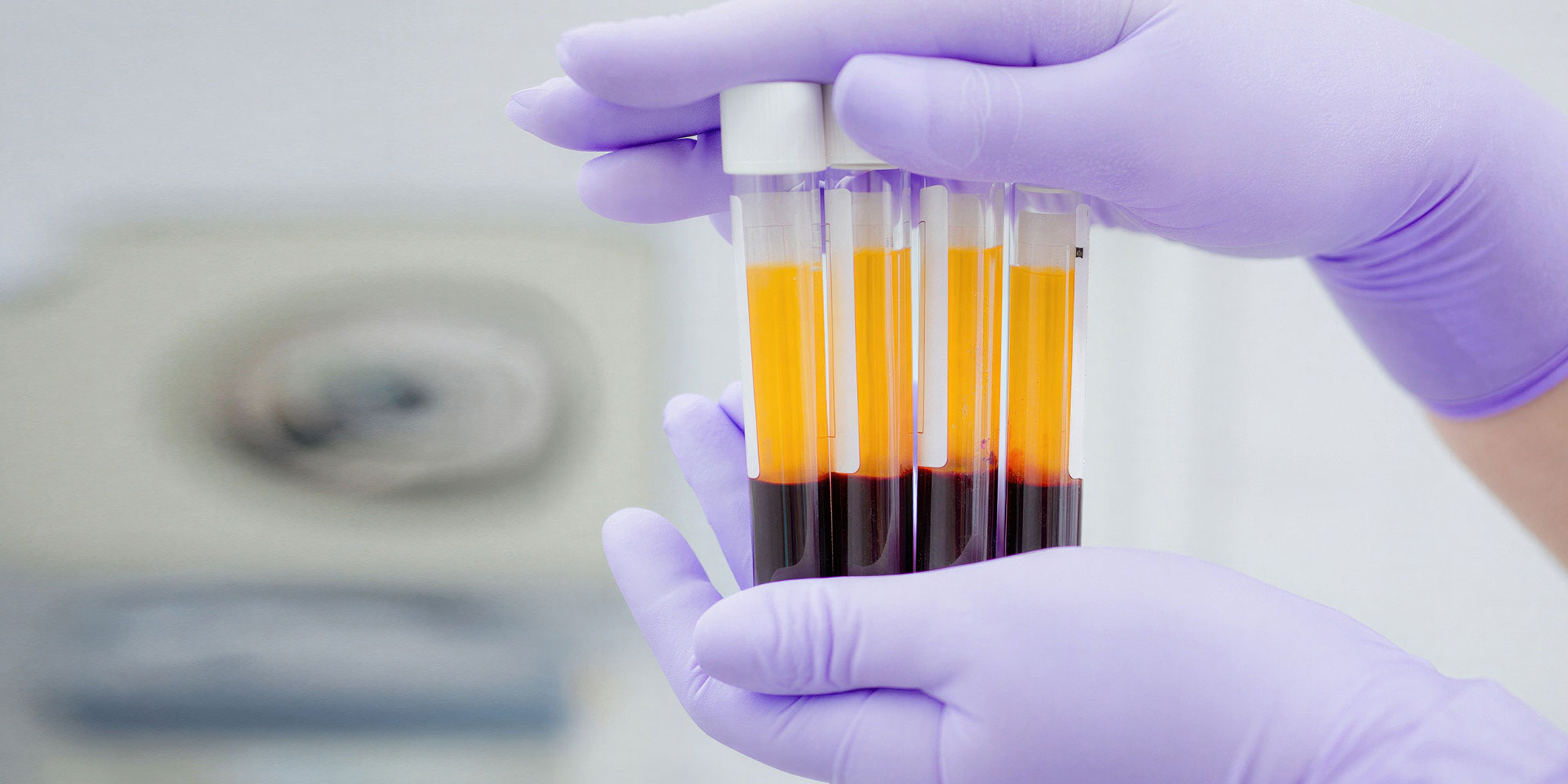 Test tubes with centrifuged blood in medical laboratory, platelet-rich plasma preparation