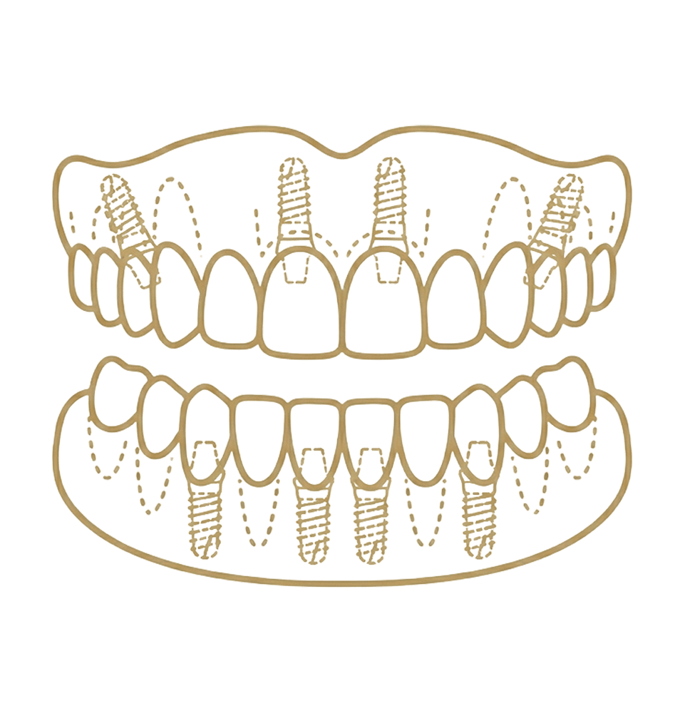 full arch dental implant icon