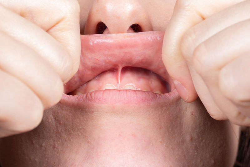 Medical inspection of the superior labial frenulum to evaluate the need for frenectomy oral surgery