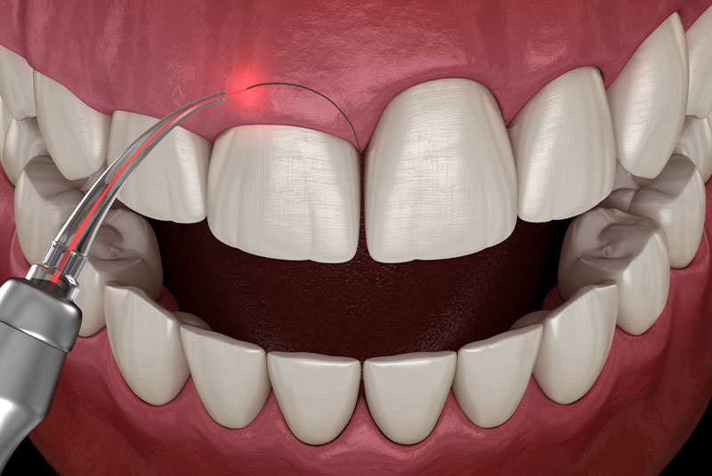 Gingivectomy surgery with laser using. Medically accurate tooth 3D illustration