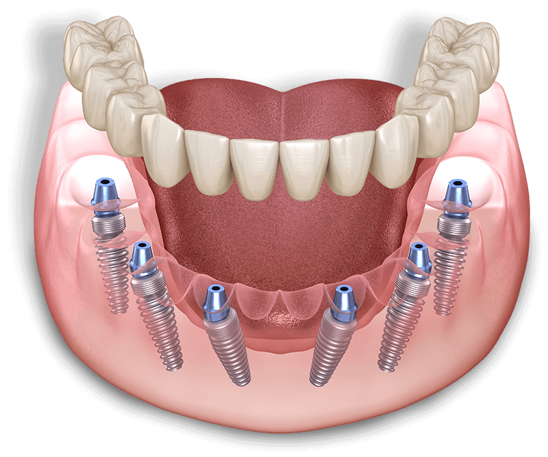 full arch dental implant