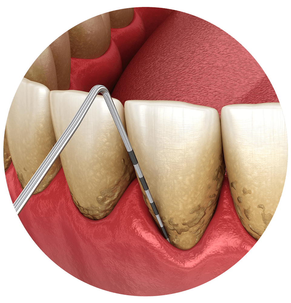 illustration of periodontics treatment