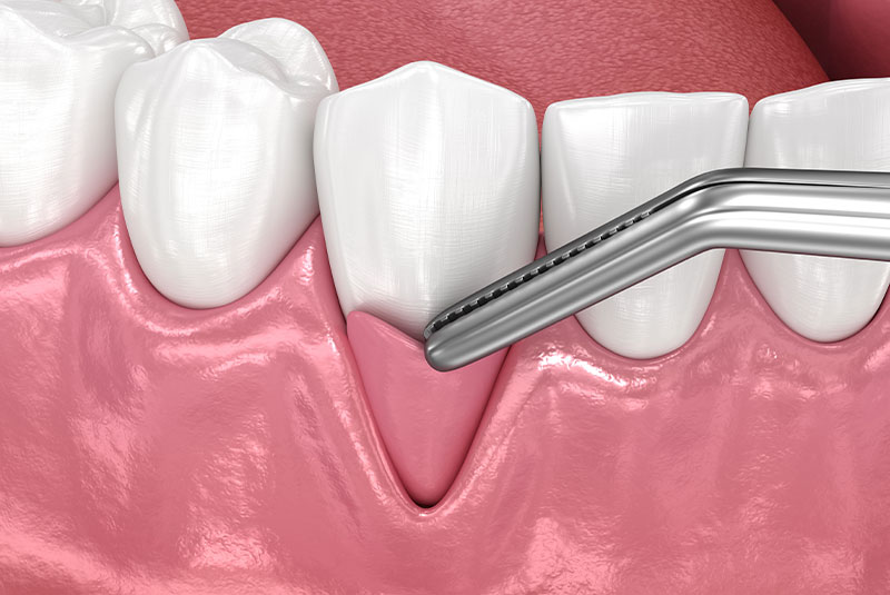 Gingiva Recession: Soft tissue graft surgery. 3D illustration of Dental treatment