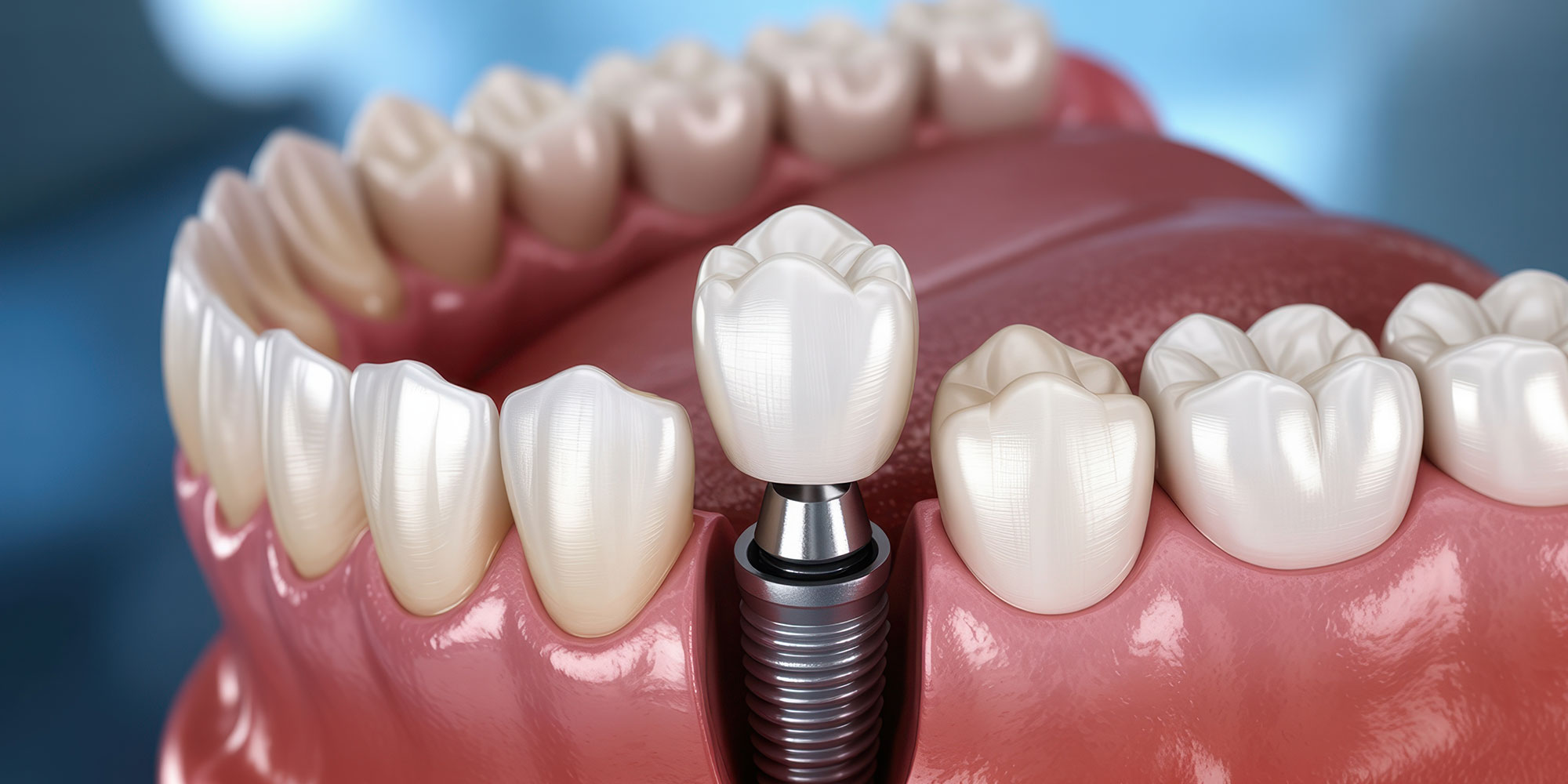 illustration if single dental implant