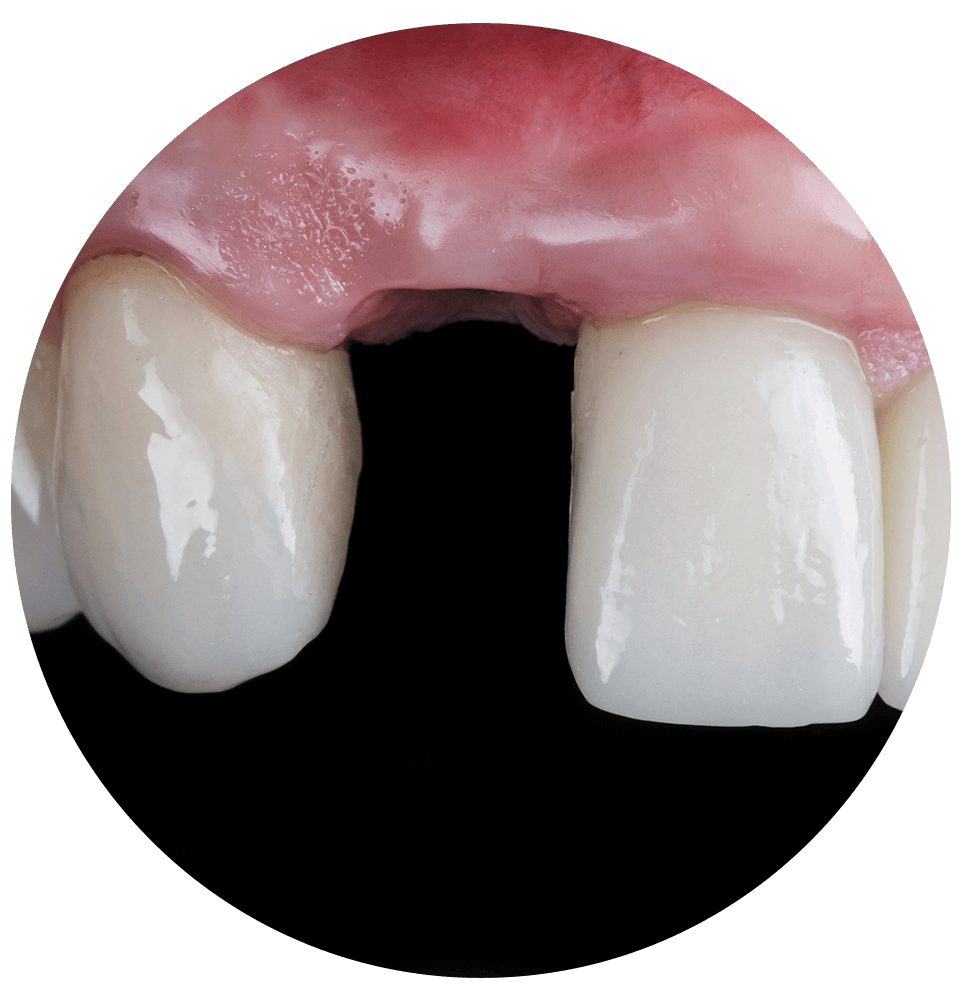 missing tooth in mouth