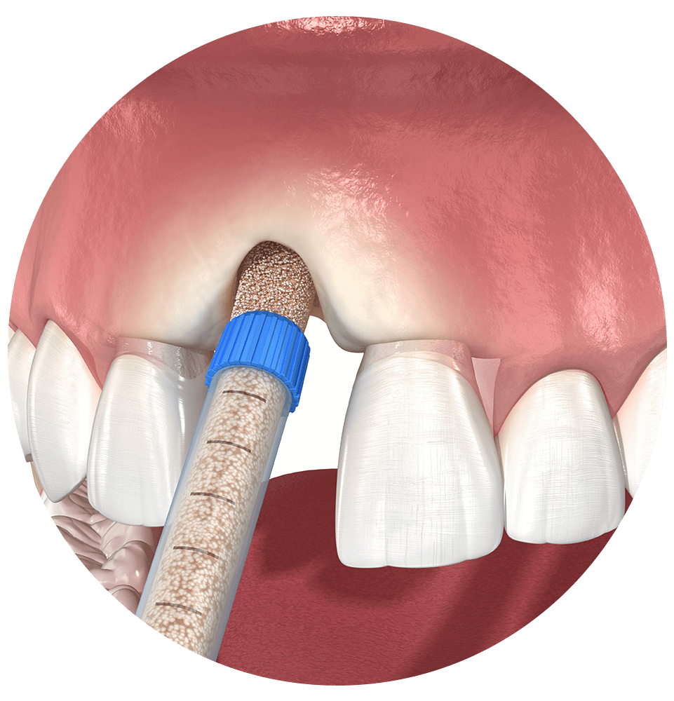 illustration of bonegrafting procedure