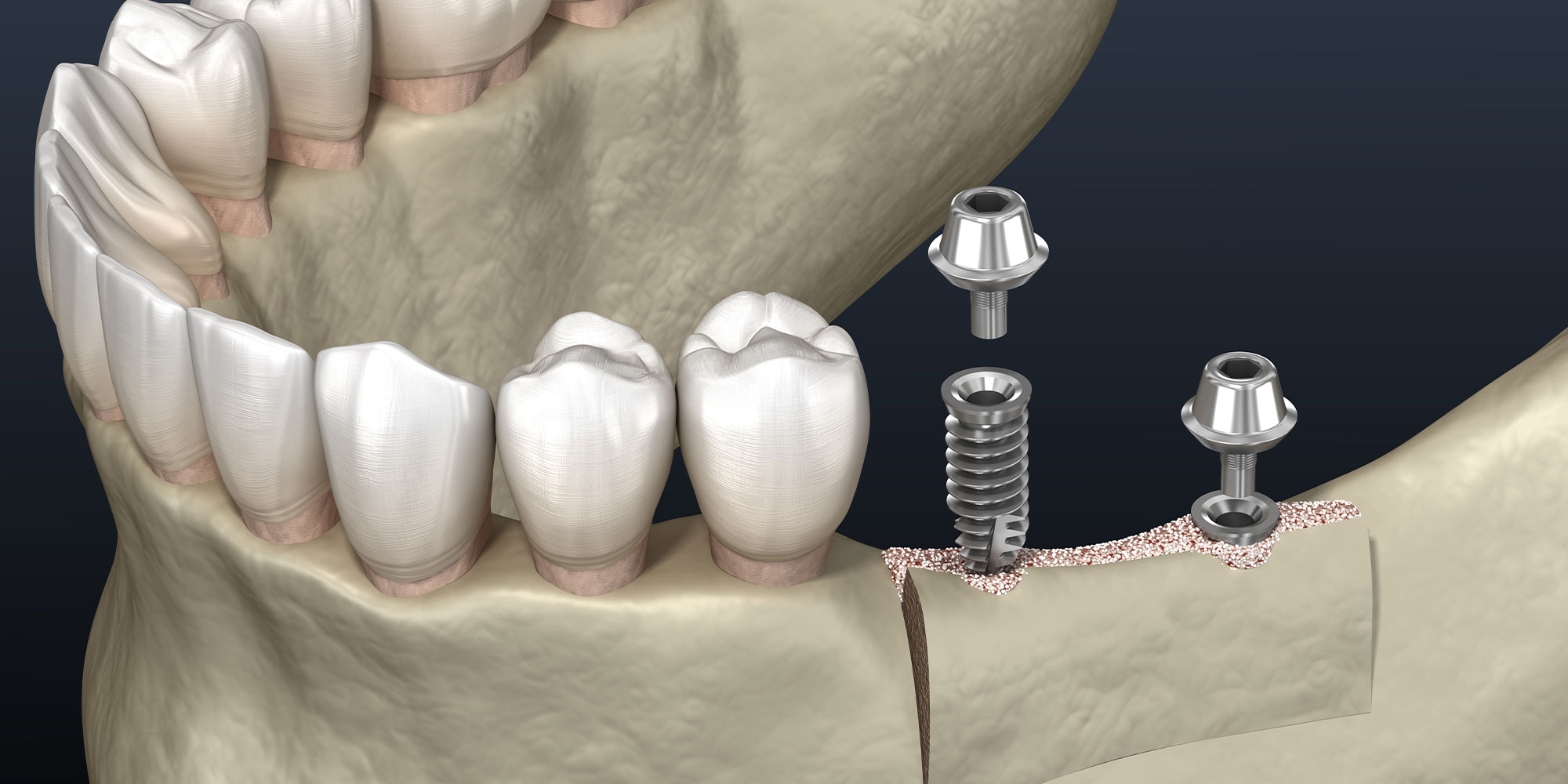 Cleavage of the alveolar ridge : implantation. Dental surgery,
