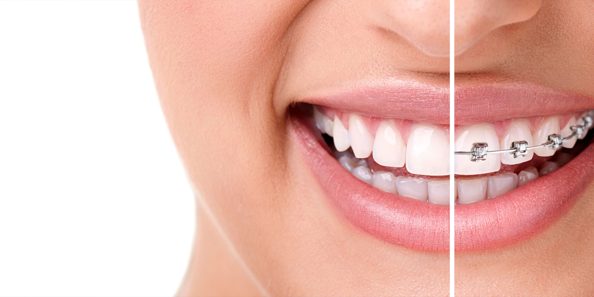 Healthy smile with braces