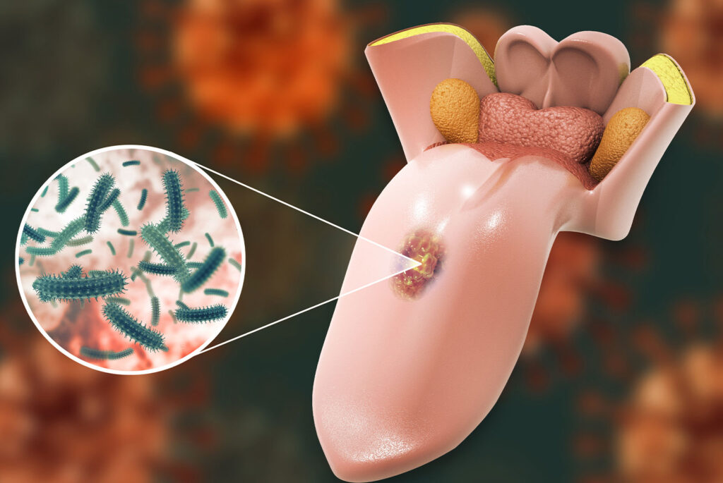 Tongue cancer medical concept or squamous cell carcinoma as malignant tumor disease. 3d illustration