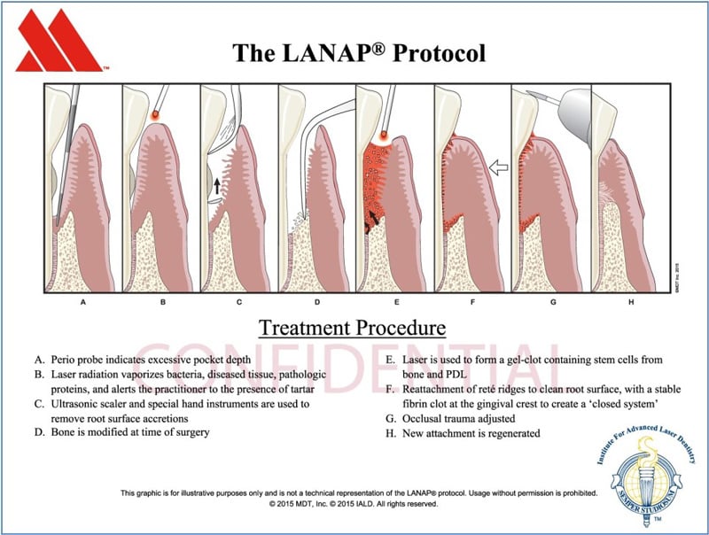 An illustration of LANAP Therapy