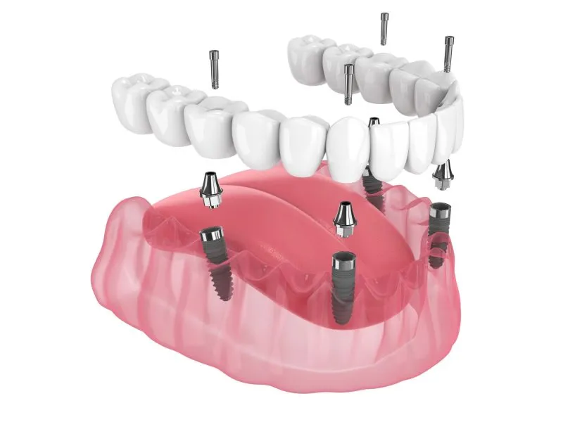 3D All-on-4 Dental Implant rendering